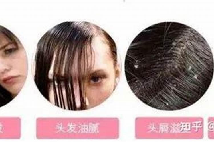 掉头发是缺少什么微量元素