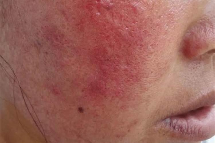 磷肥伤了手怎么办？