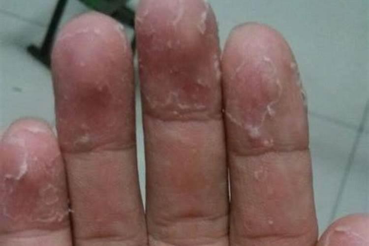 草坪被肥料烧伤后怎样办？