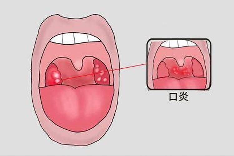 龙牙百合树腐烂倒塌了,得什么病了？该用什么药？怎么办？谢谢