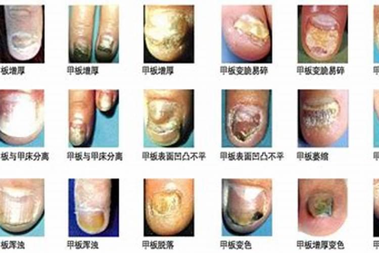 甲卫士治疗灰指甲效果怎么样？