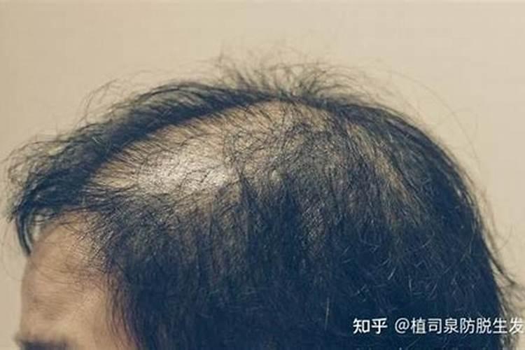 头发稀少用什么生发好